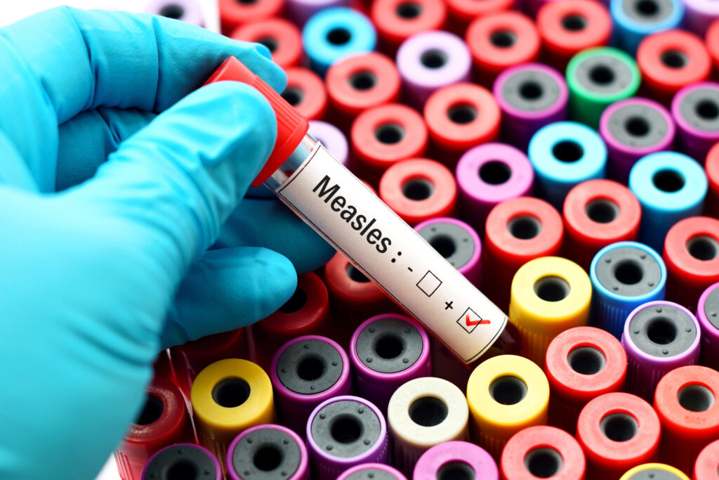 Blood sample positive with Measles virus (Getty Images)