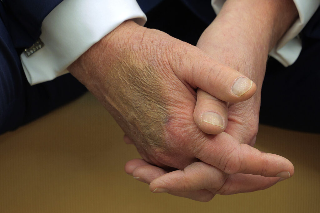 Makeup covers a bruise on the back of U.S. President Donald Trump's hand as he hosts French President Emmanuel Macron for meetings at the White House on Feb. 24, 2025 in Washington, D.C. (Photo by Chip Somodevilla/Getty Images)